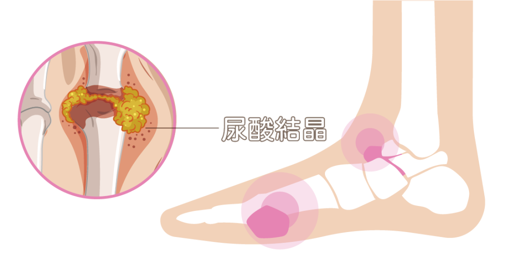 痛風治療全攻略｜從發作急救到日常預防，打造無痛人生